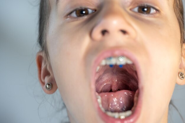 The Benefits of Custom-Fit Mouth Guards for Children and Adults
